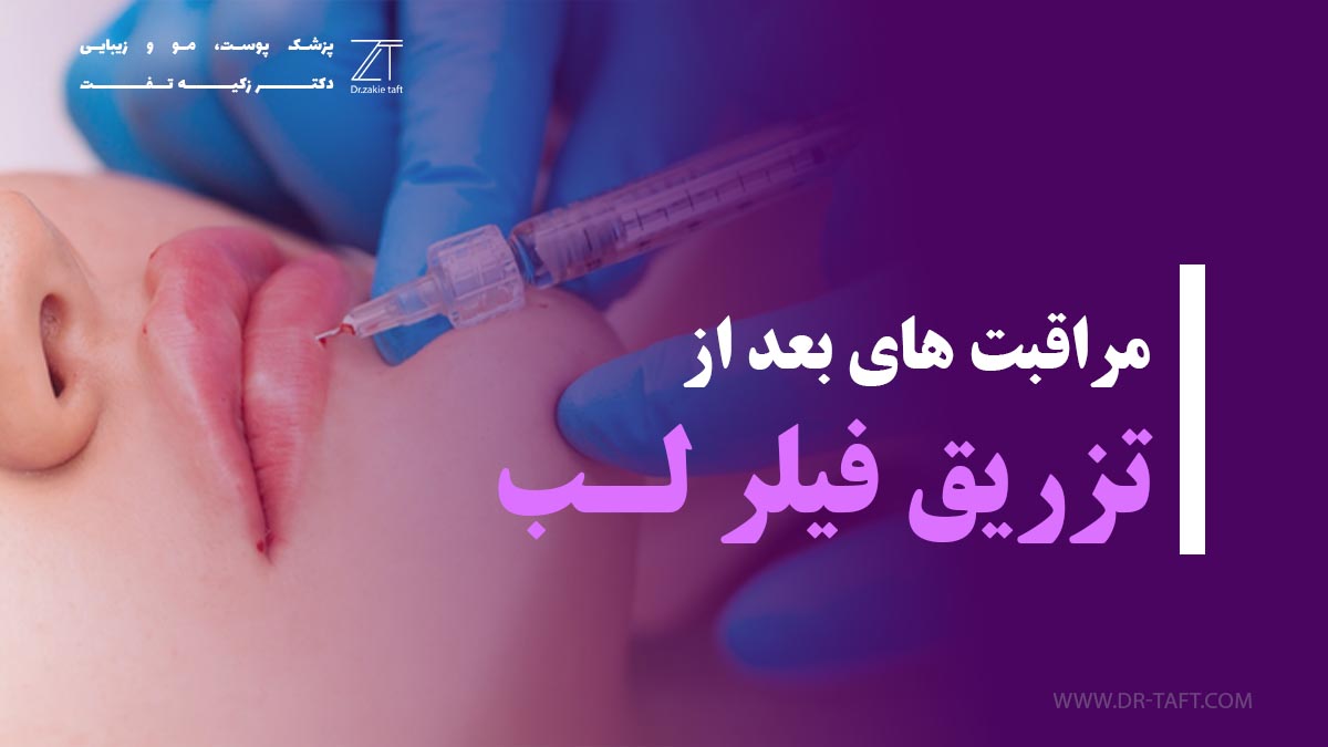مراقبت بعد از تزریق فیلر لب