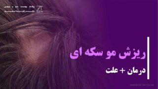 ریزش مو سکه ای