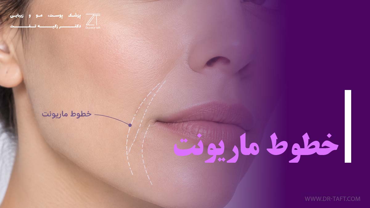 خطوط ماریونت