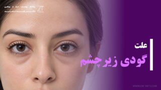 علت گودی زیرچشم