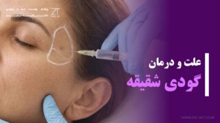 گودی شقیقه