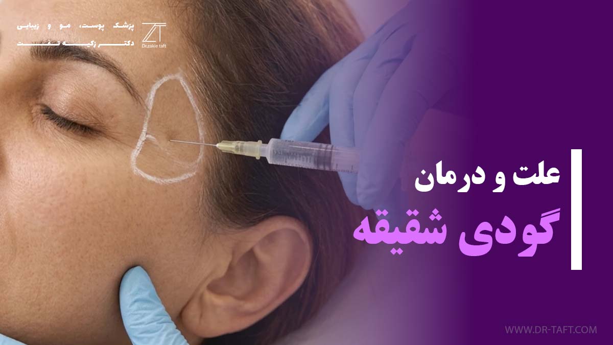 گودی شقیقه